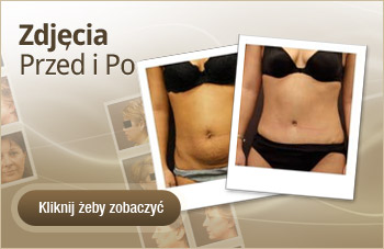 Chirurgia plastyczna - Zdjęcia przed i po operacji plastycznej